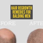 Reverse male pattern baldness: Home remedies for hair regrowth in balding men