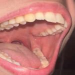 Scientists develop a regenerative therapy that may bring back teeth |