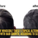 5 topical minoxidil alternatives to increase hair growth