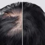 Losing hair because of Alopecia? This Arthritis drug can help you regrow hair like never before |