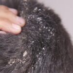 5 hair oils that may be making your dandruff worse