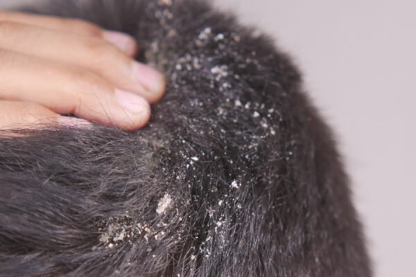 5 hair oils that may be making your dandruff worse