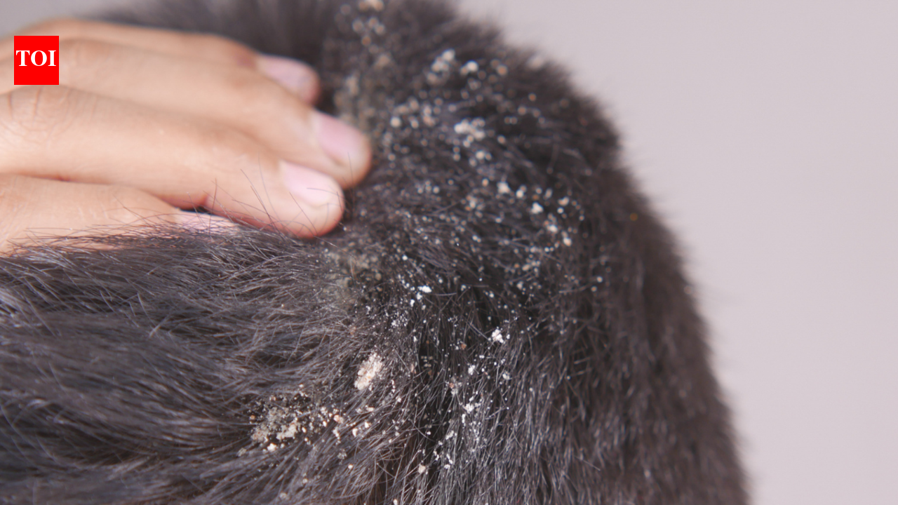 5 hair oils that may be making your dandruff worse