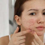 Pigmentation, acne scars or ageing? 5 questions that can help identify the right treatment path