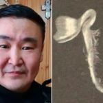A 42-year-old Russian man suffers months of agonising headaches after a seed sprouts inside his eye following a branch injury during a summer trip |